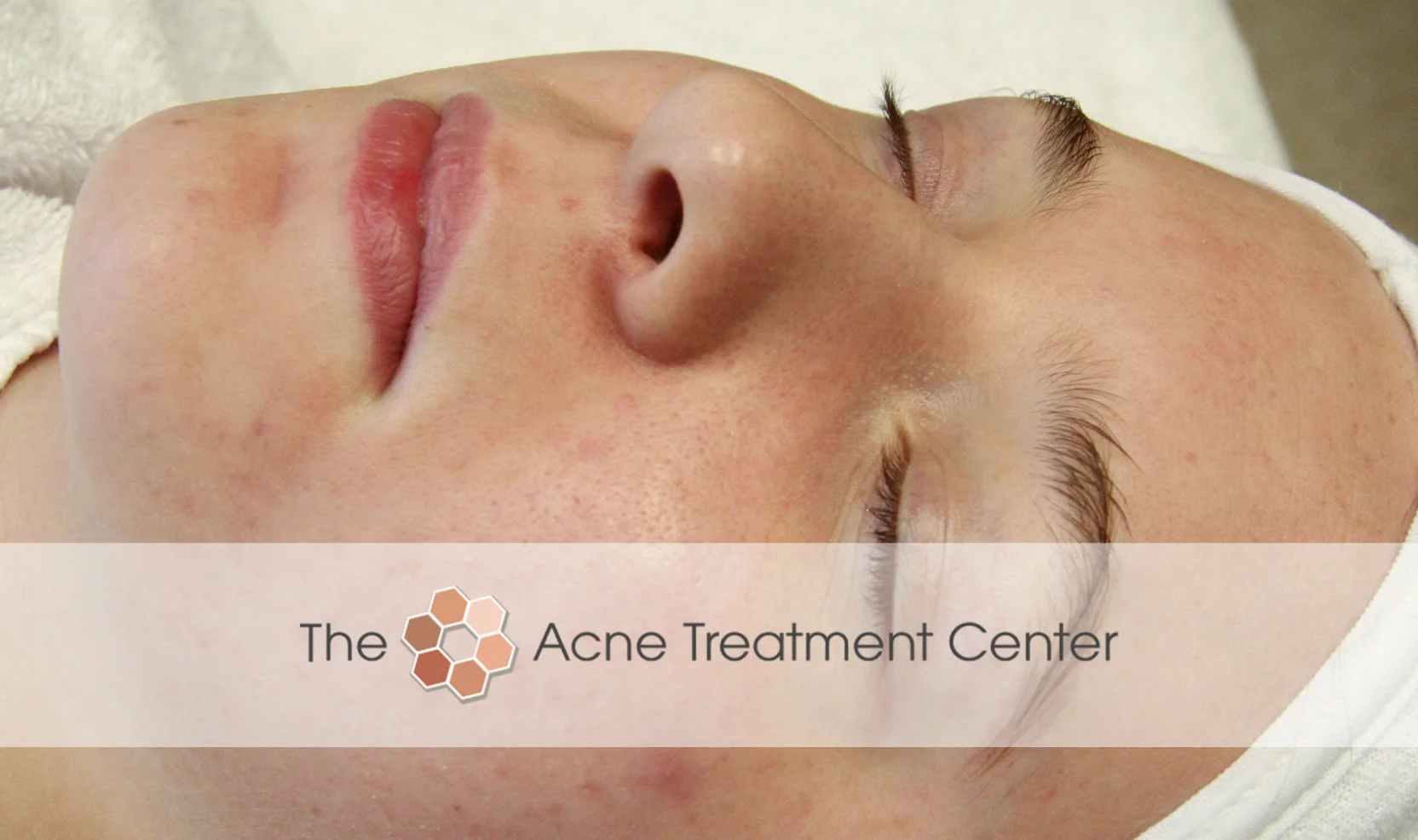Non Inflamed Acne Treatment Photo