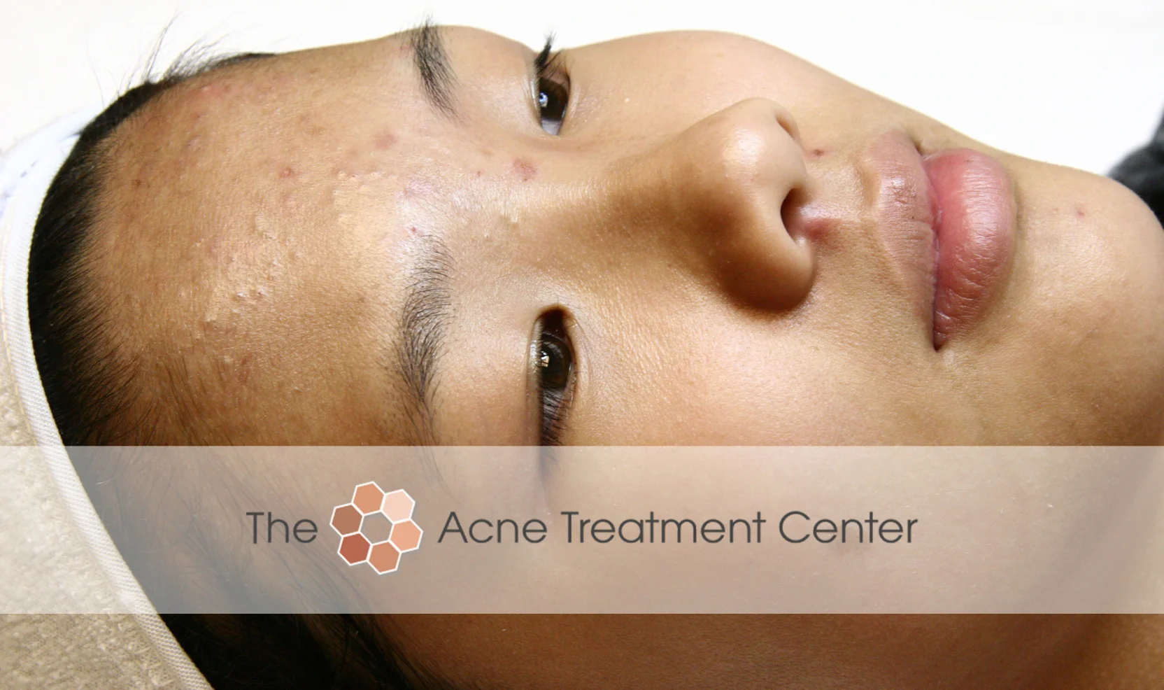 Non Inflamed Acne Treatment Photo
