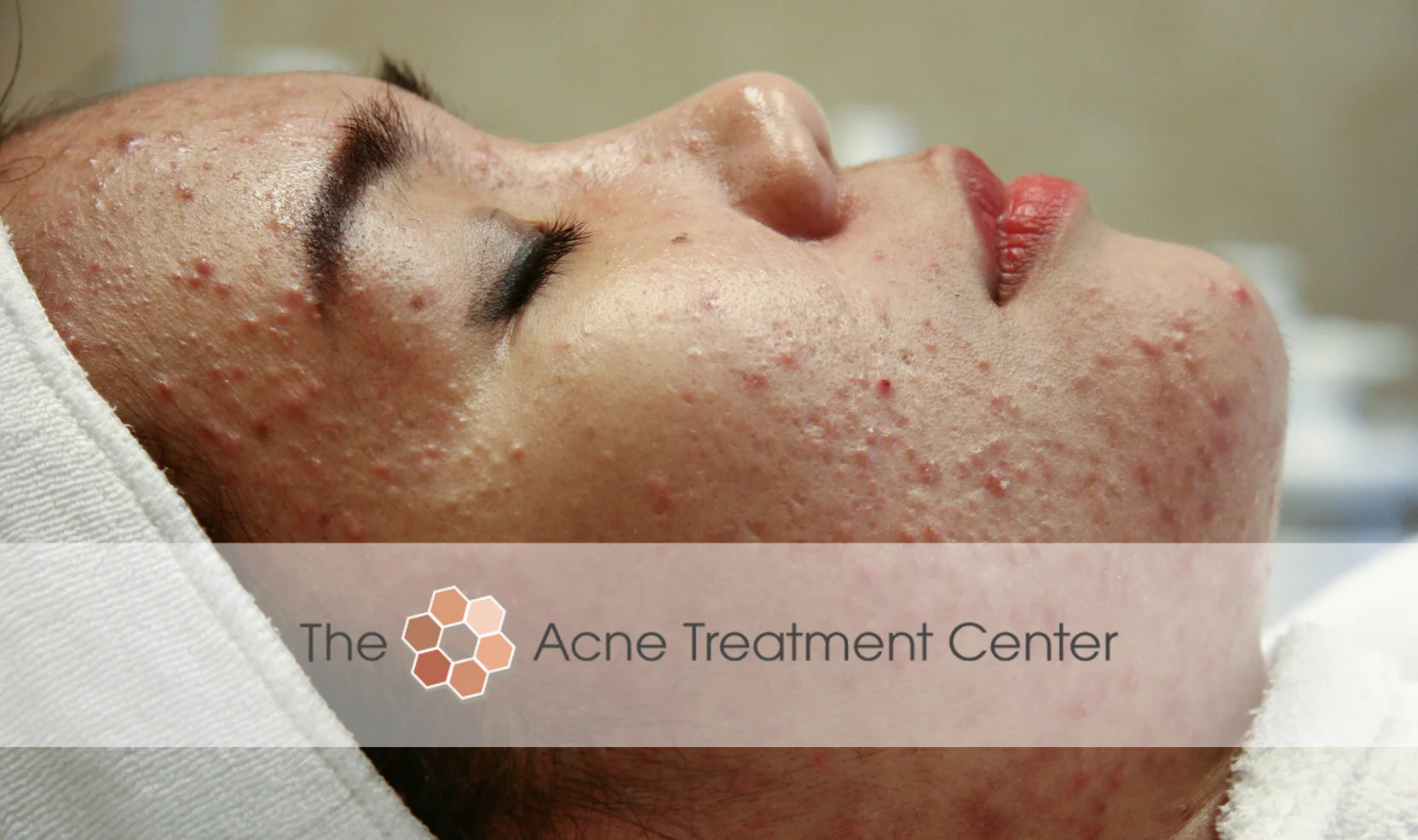 Non Inflamed Acne Treatment Photo