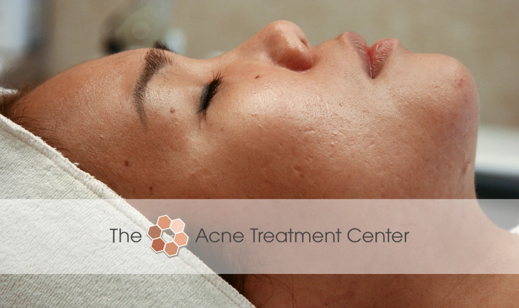 Non Inflamed Acne Treatment Photo