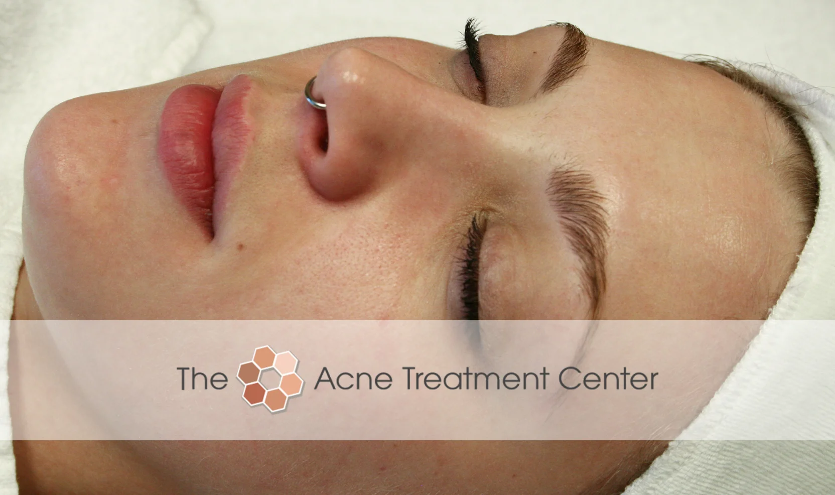 Non Inflamed Acne Treatment Photo