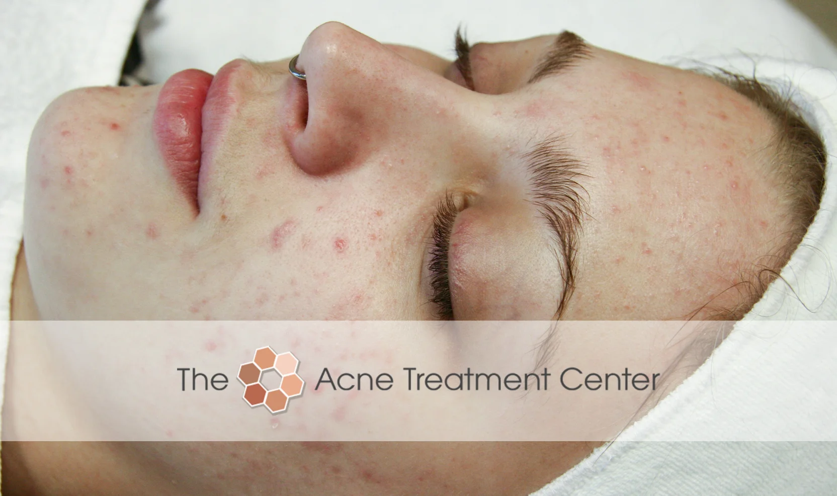 Non Inflamed Acne Treatment Photo