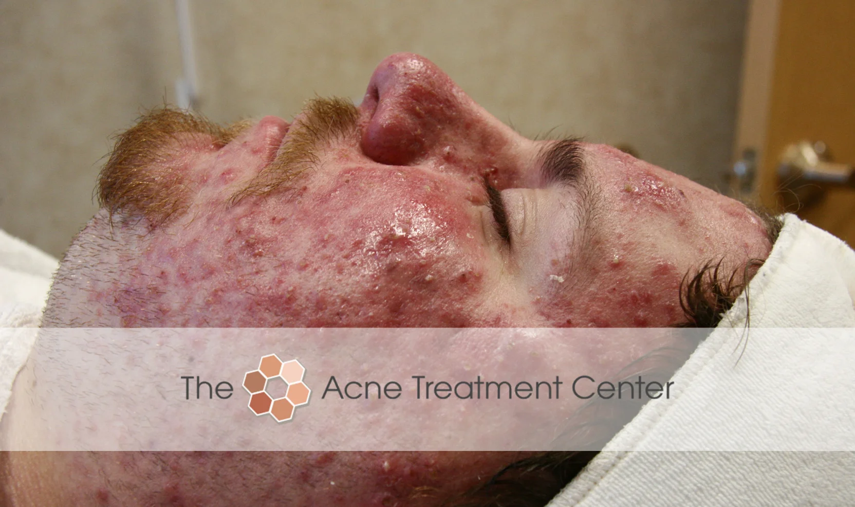 Rocasea Acne Treatment Photo