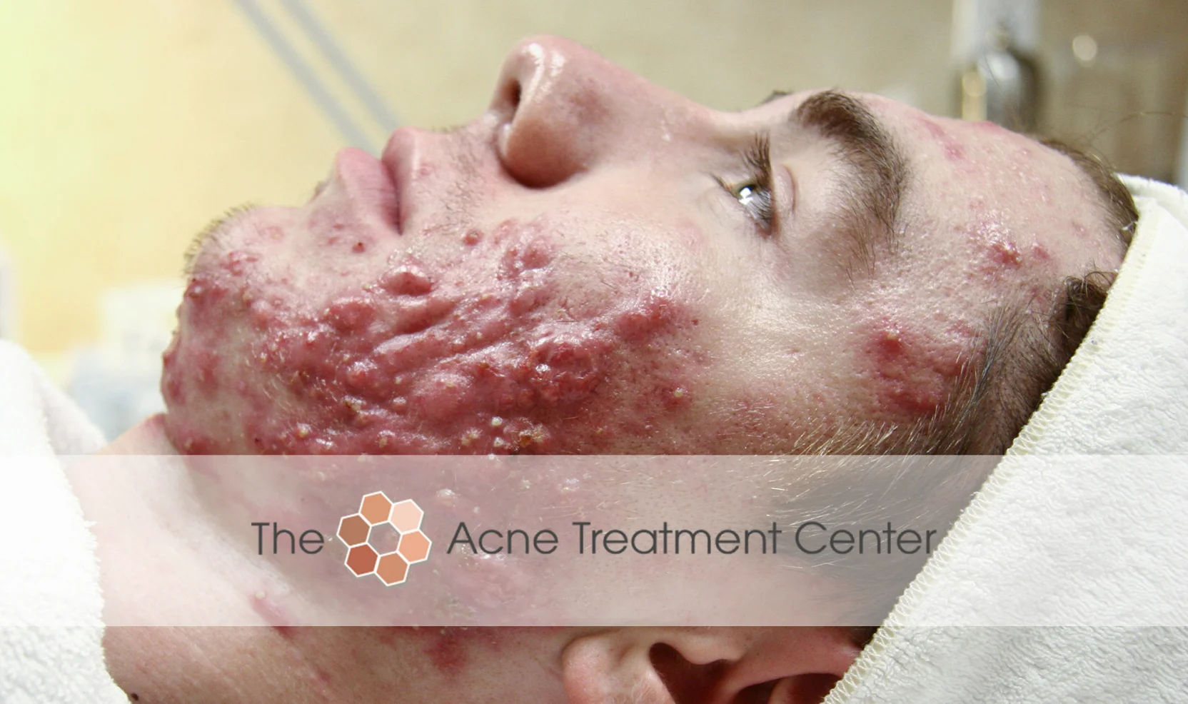 Conglobata Acne Treatment Photo