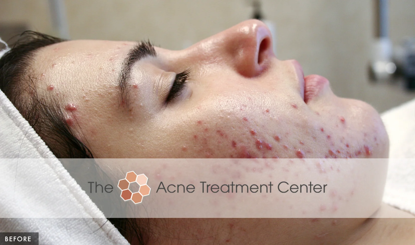 Inflamed Acne Treatment Photo