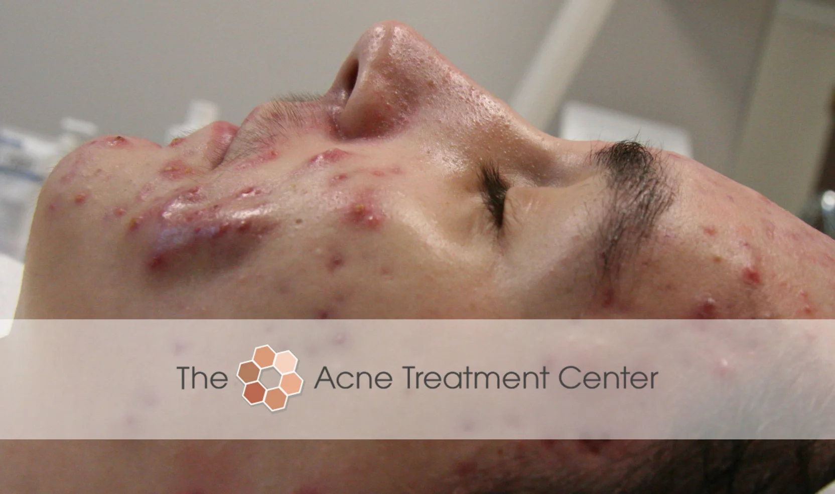 Conglobata Acne Treatment Before Photo