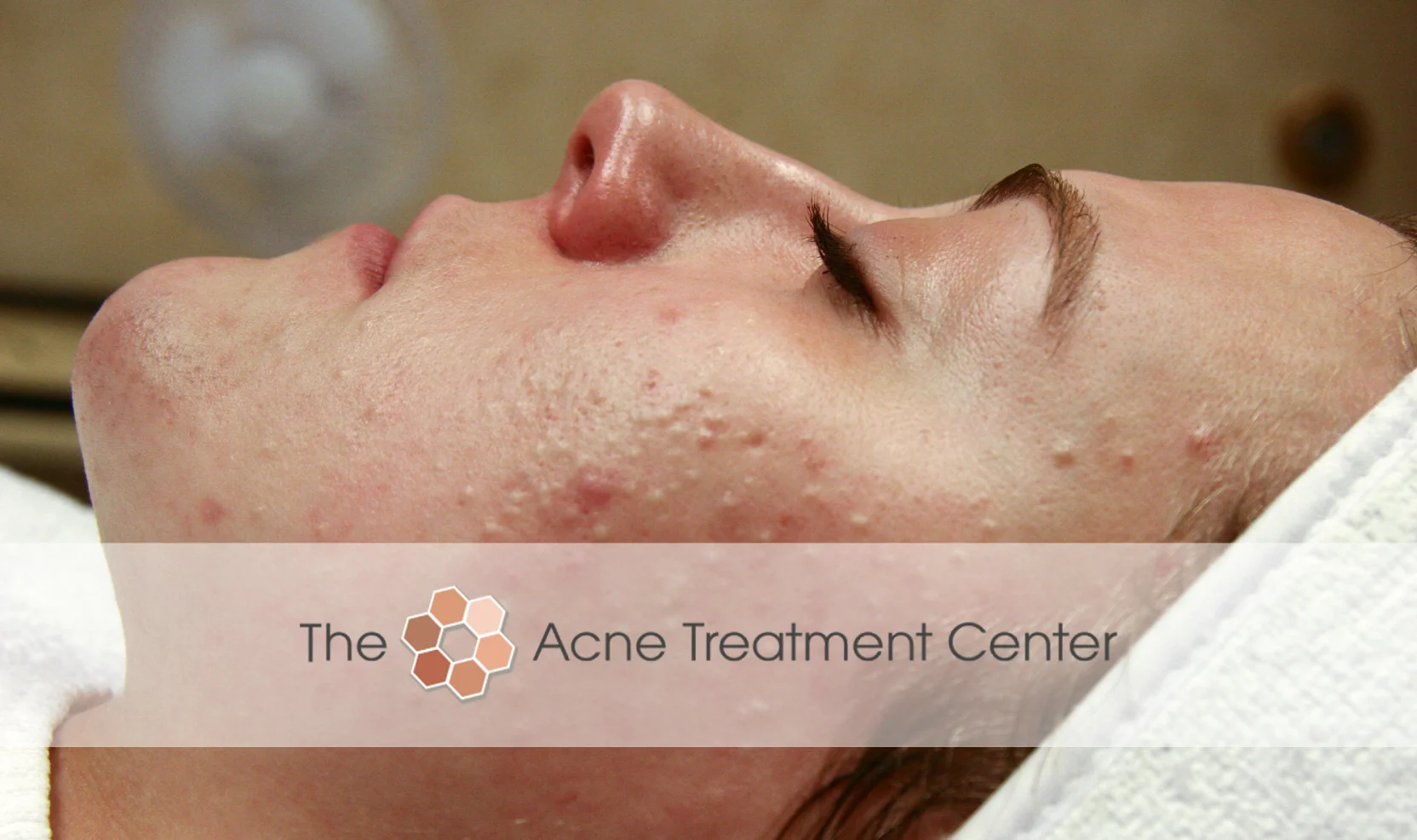 Non Inflamed Acne Treatment Photo