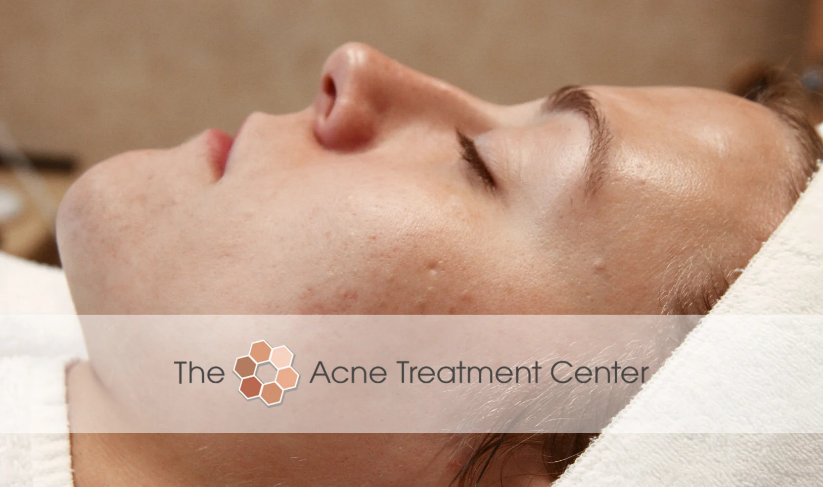 Non Inflamed Acne Treatment Photo