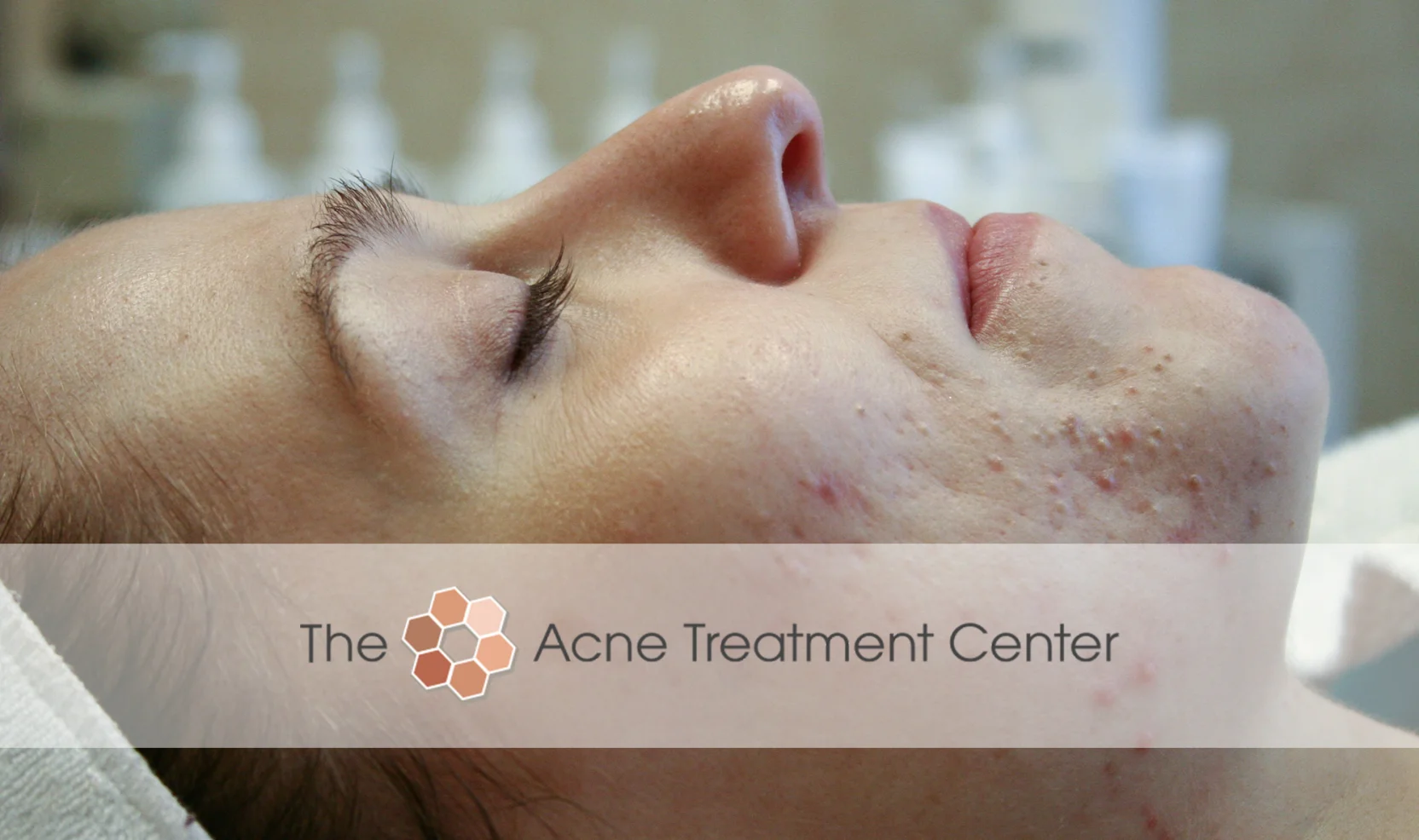 Combination Acne Treatment Photo