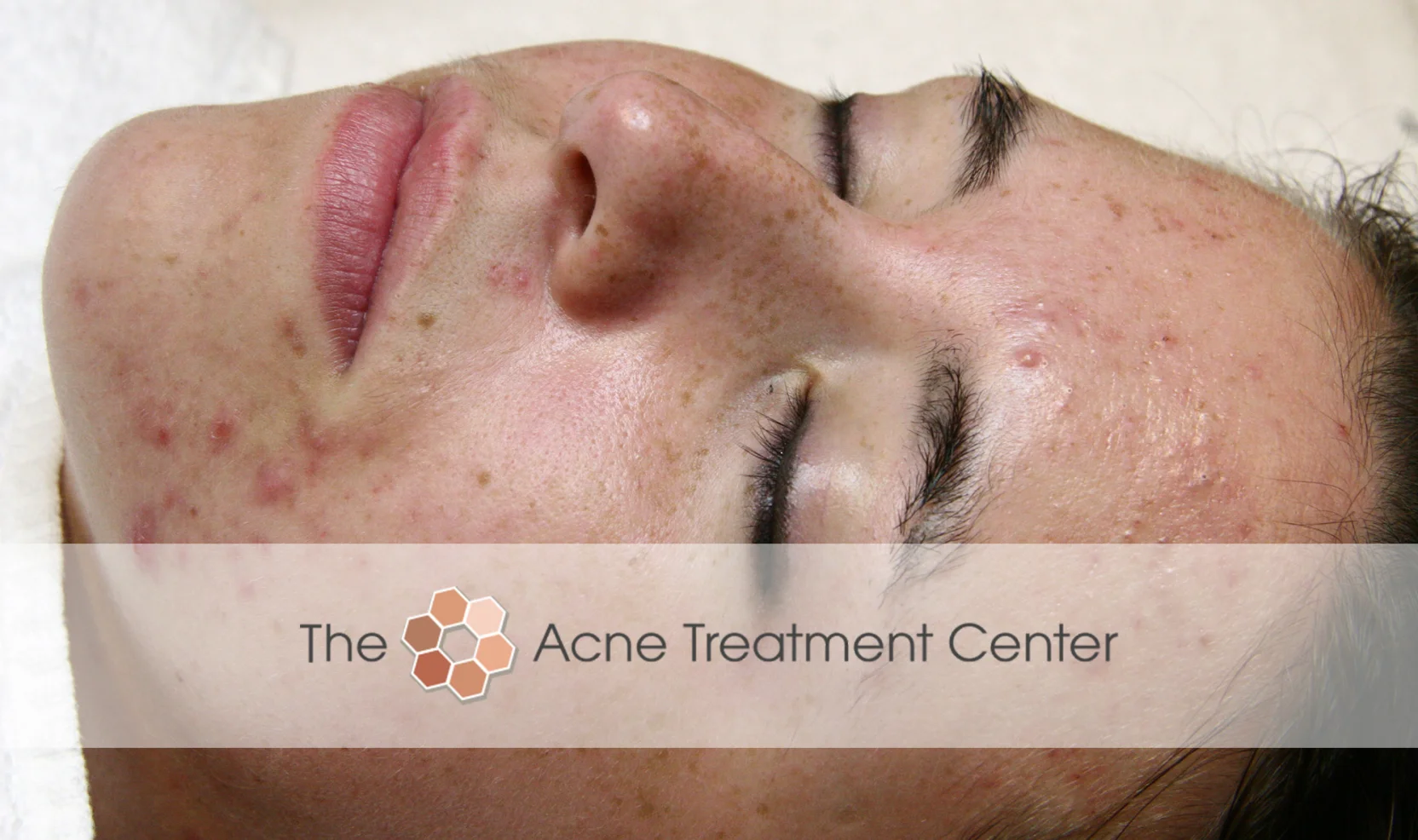 Combination Acne Treatment Photo