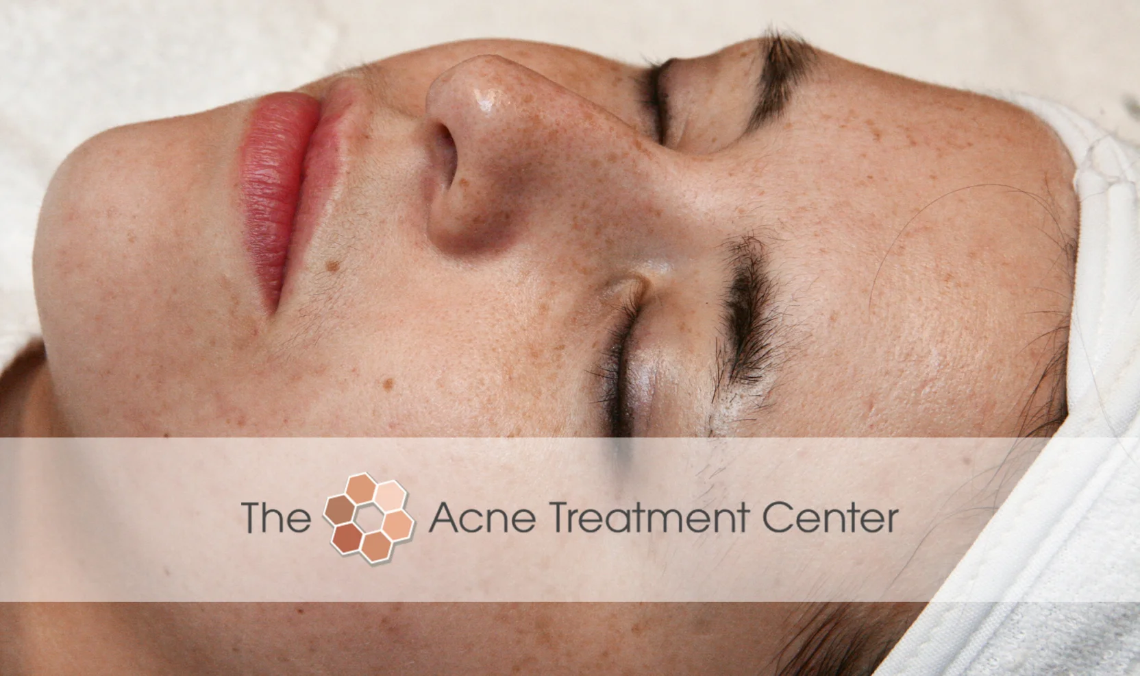 Combination Acne Treatment Photo