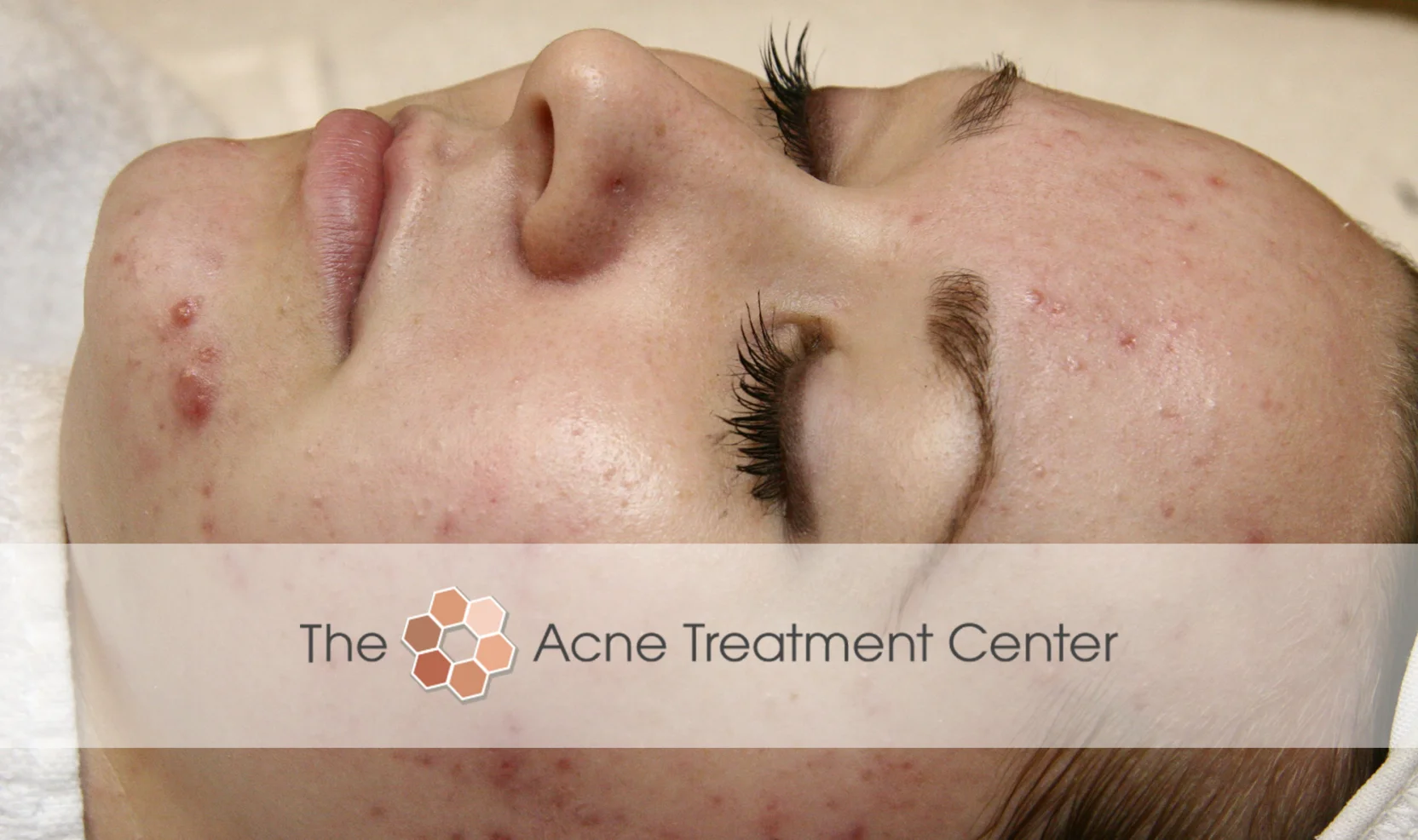 Combination Acne Treatment Photo