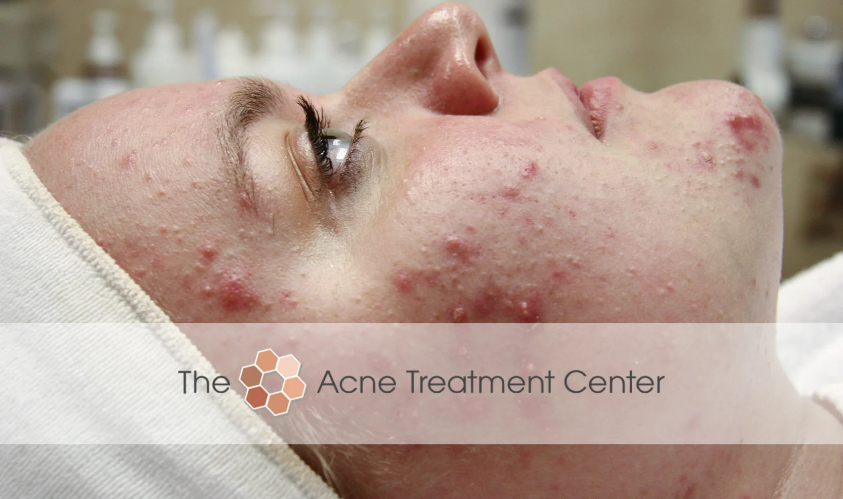 Combination Acne Treatment Photo