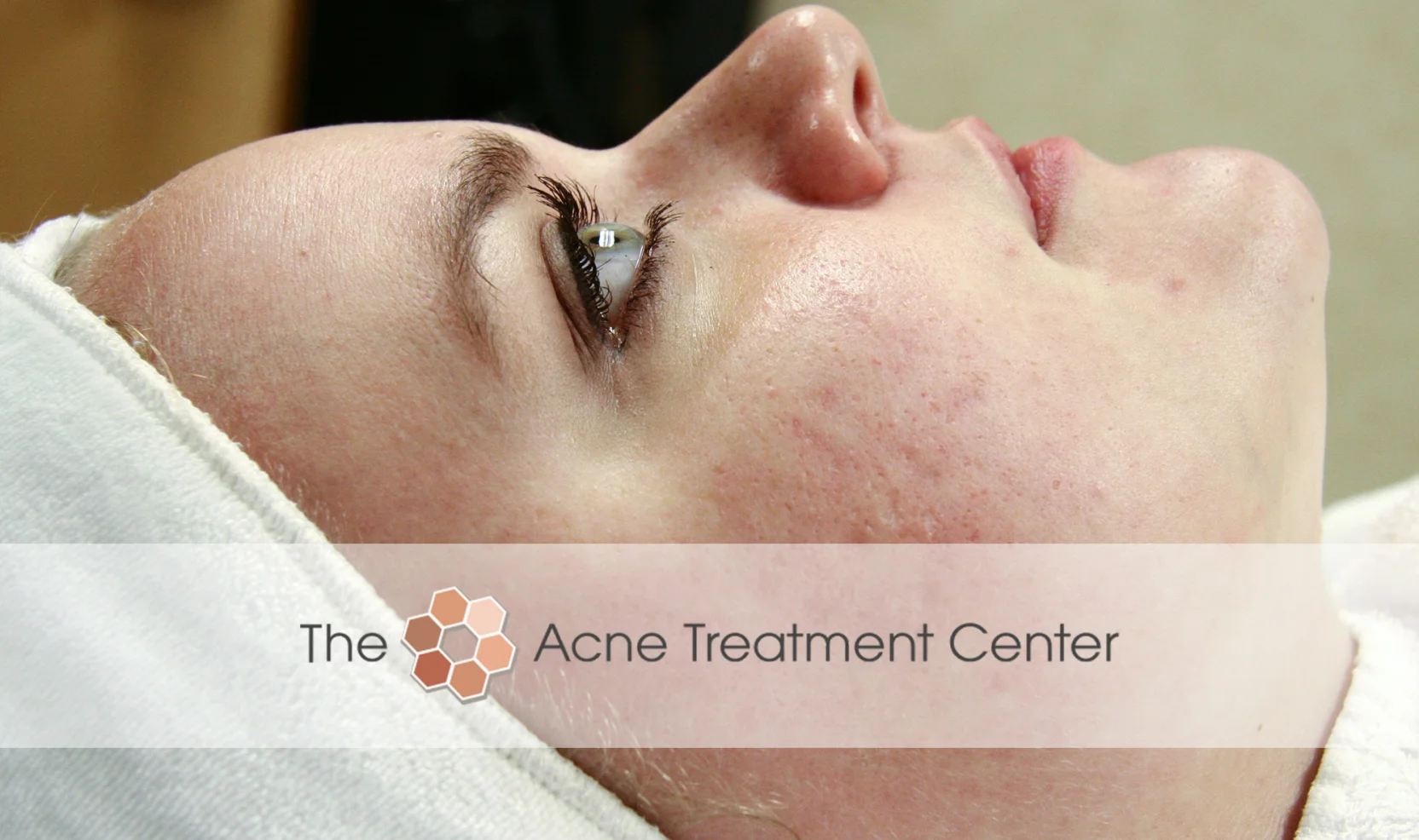 Combination Acne Treatment Photo
